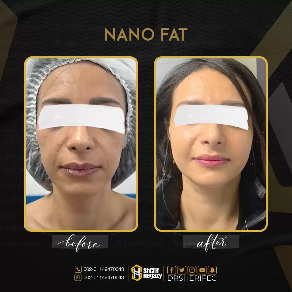 نتيجة-حقن-الدهون-Nano-Fat-للوجه